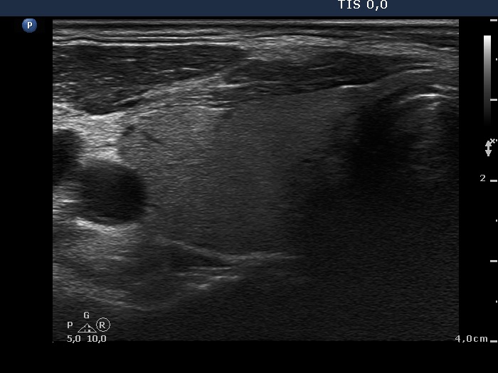 Right lobe, horizontal view