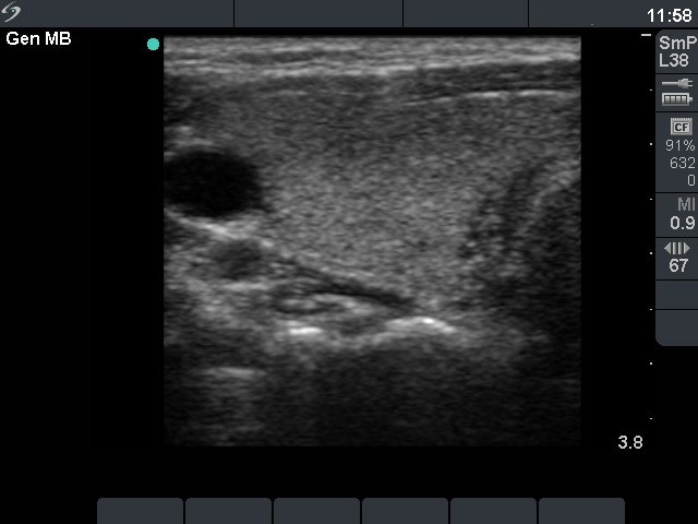 Right lobe, longitudinal scan