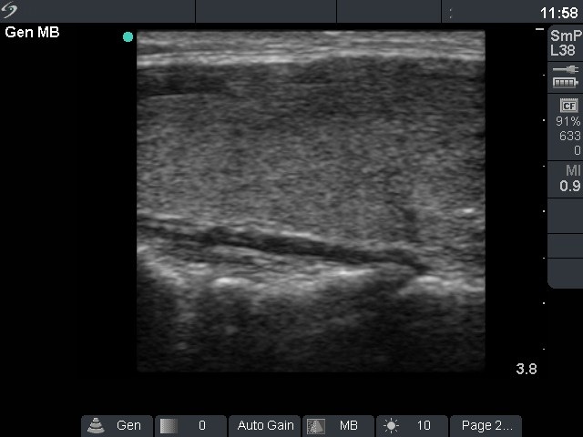 Right lobe, longitudinal scan
