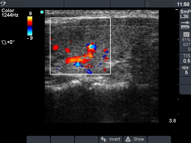 Right lobe, longitudinal scan