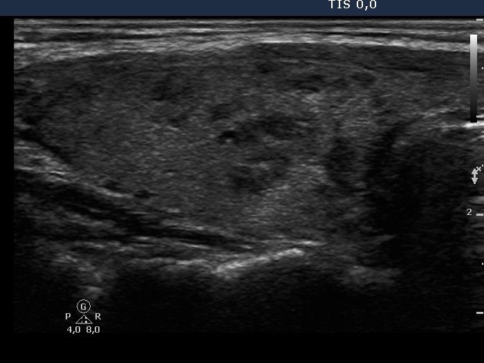 Right lobe, longitudinal scan