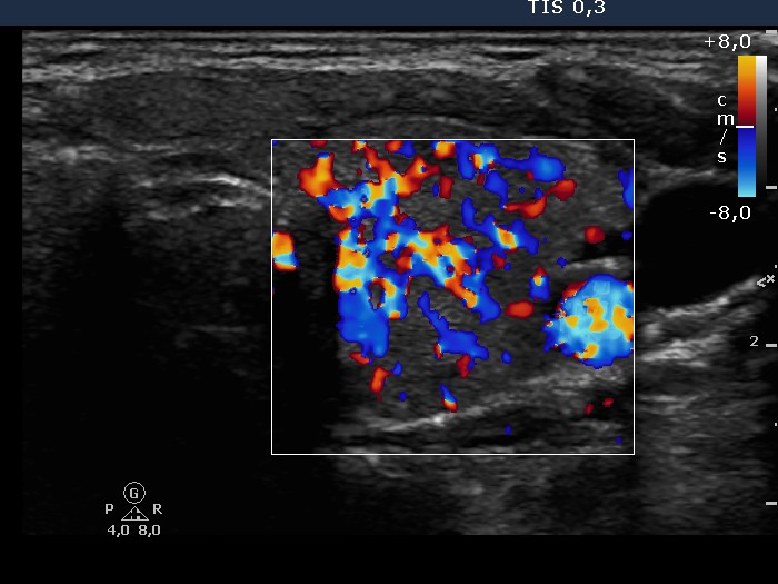 Right lobe, longitudinal scan