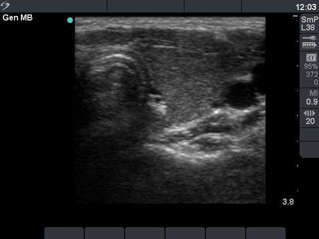 Right lobe, longitudinal scan