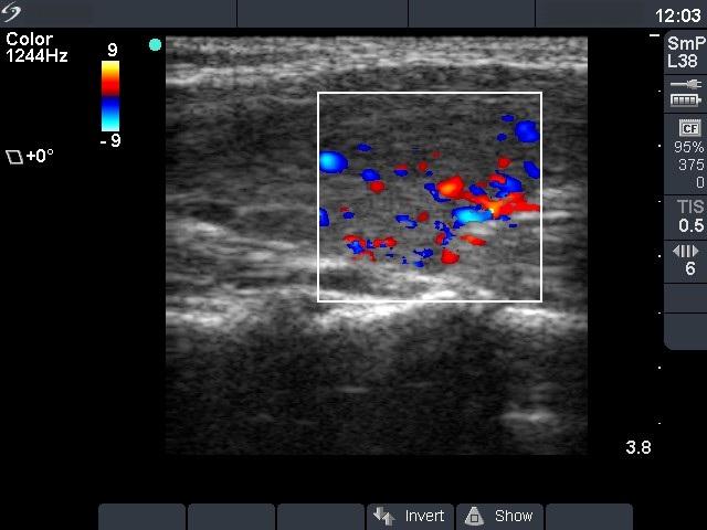 Right lobe, longitudinal scan