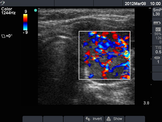 Right lobe, horizontal view