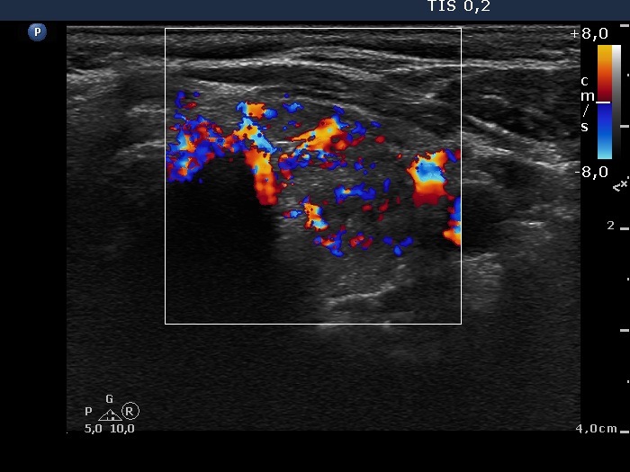 Right lobe, longitudinal scan