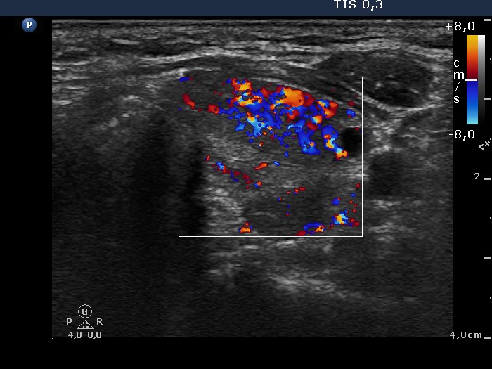 Right lobe, longitudinal scan