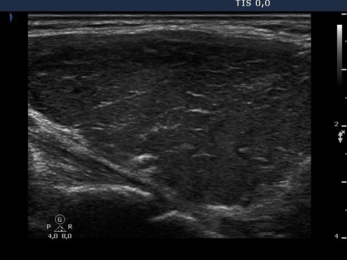 Right lobe, longitudinal scan