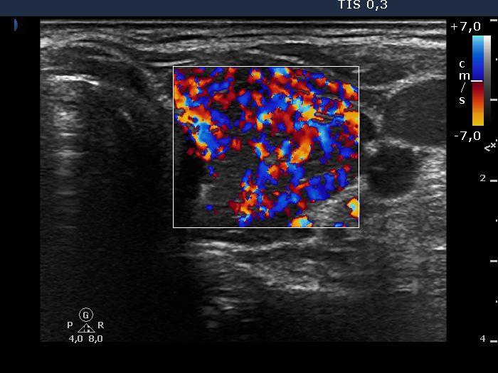 Right lobe, longitudinal scan