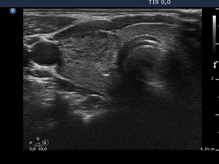 Right lobe, longitudinal scan