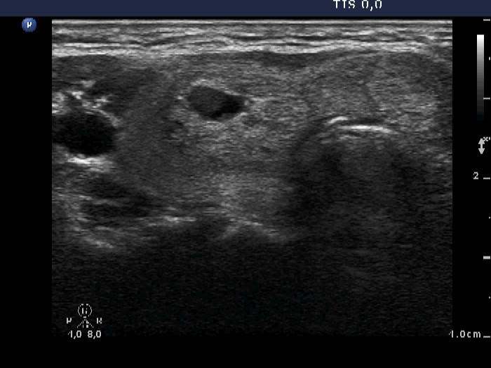 Right lobe, longitudinal scan