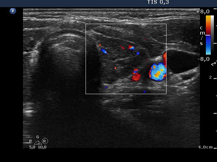 Right lobe, horizontal view