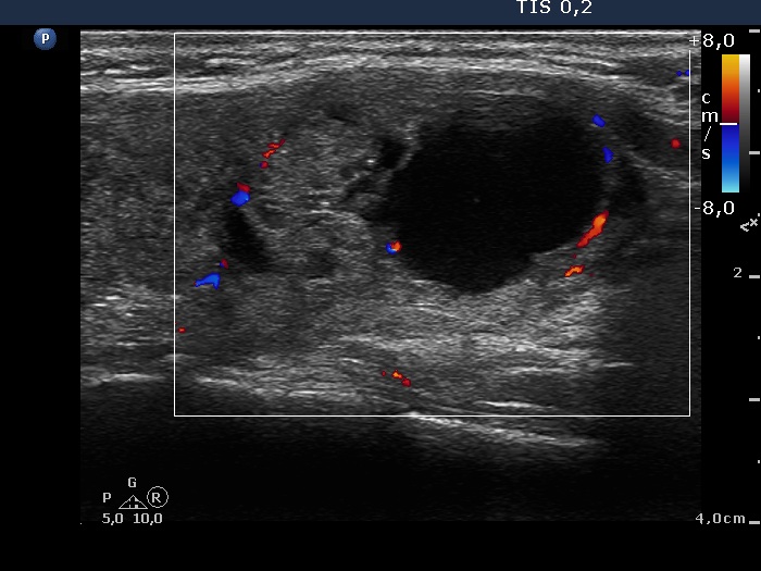 Right lobe, longitudinal scan