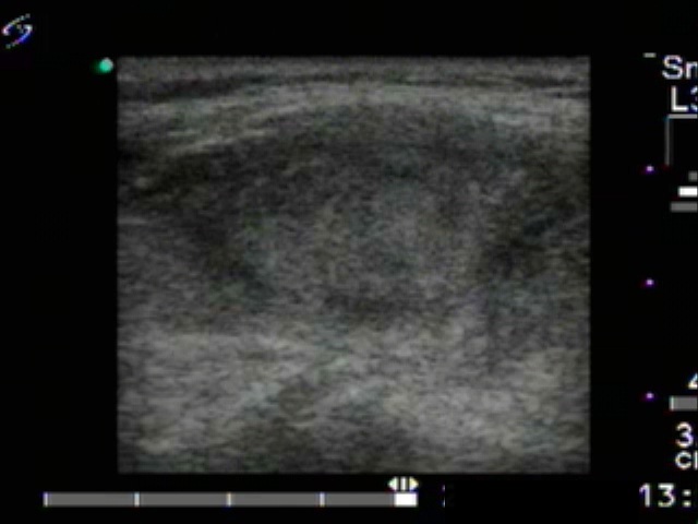 Right lobe, longitudinal scan