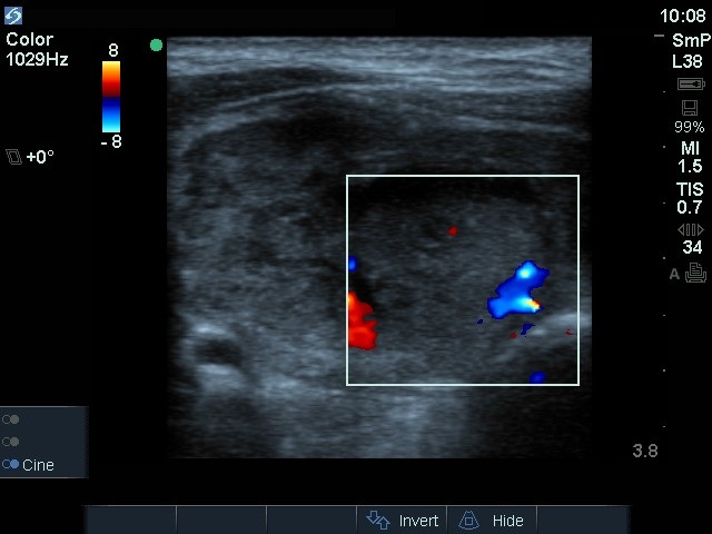Right lobe, longitudinal scan