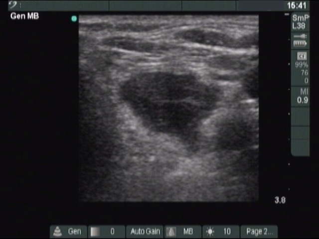 Right lobe, longitudinal scan