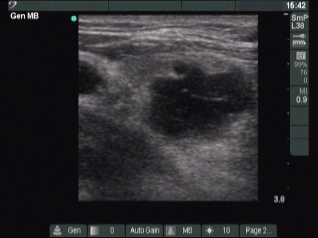 Right lobe, longitudinal scan