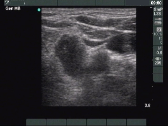 Right lobe, longitudinal scan