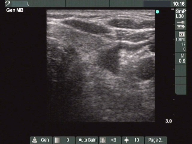 Right lobe, longitudinal scan