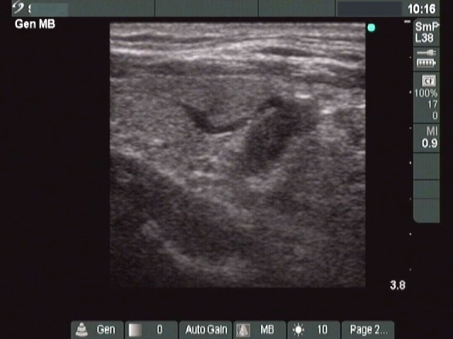 Right lobe, longitudinal scan