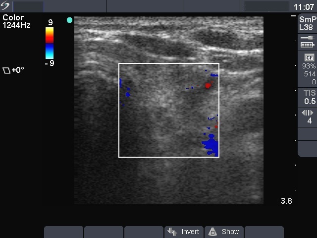 Right lobe, longitudinal scan