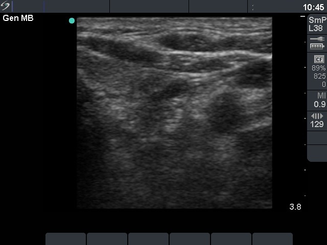 Right lobe, longitudinal scan