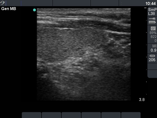 Right lobe, longitudinal scan