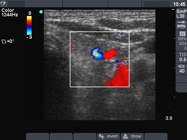 Right lobe, longitudinal scan