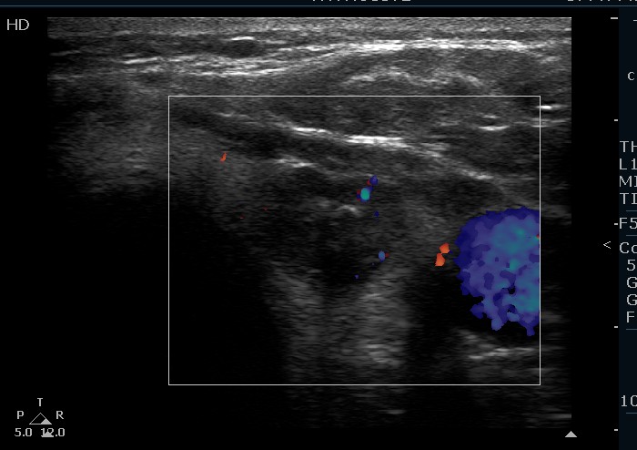 Right lobe, longitudinal scan