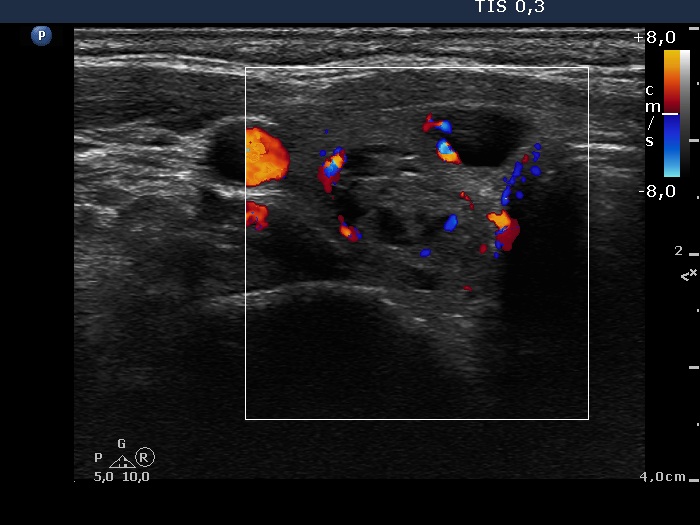 Right lobe, longitudinal scan