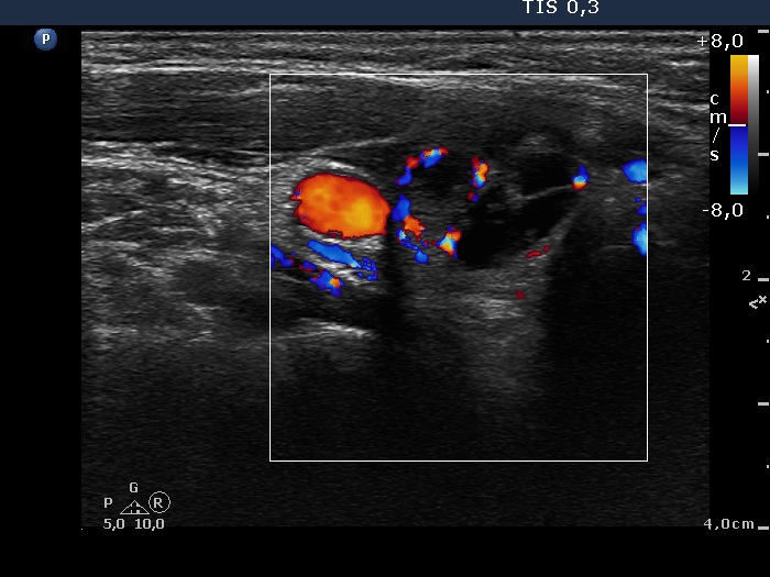 Right lobe, longitudinal scan