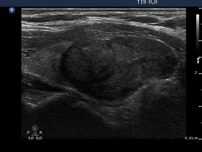 Right lobe, longitudinal scan