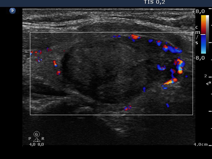 Right lobe, longitudinal scan