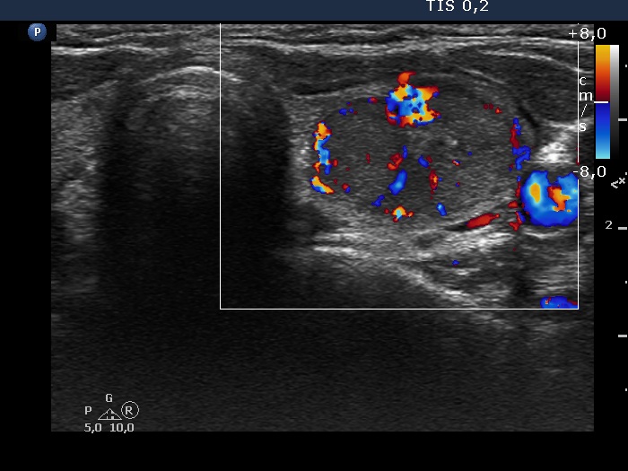 Right lobe, longitudinal scan