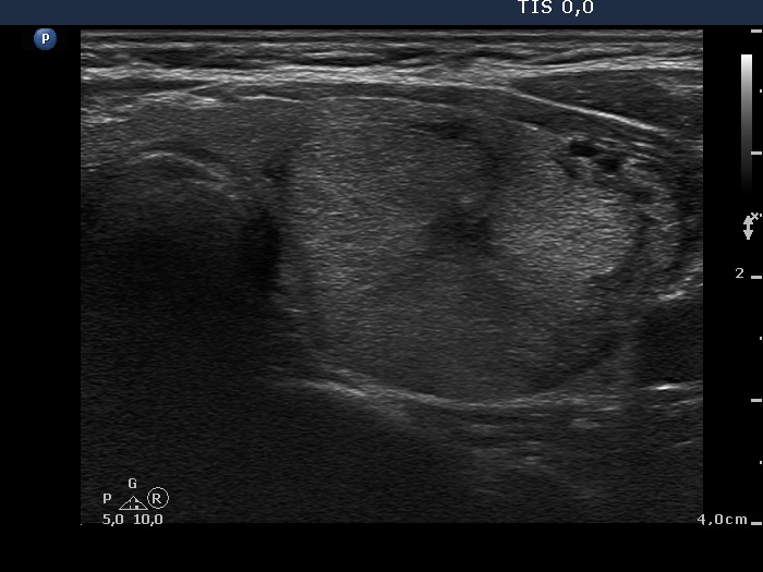 Right lobe, longitudinal scan