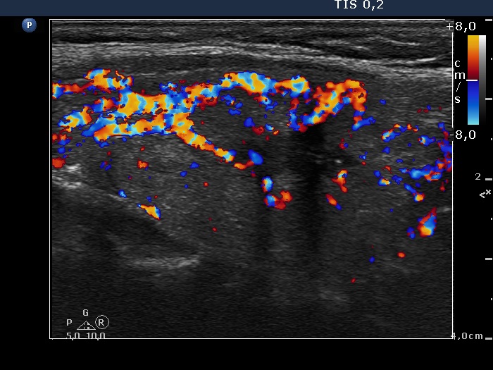 Right lobe, longitudinal scan