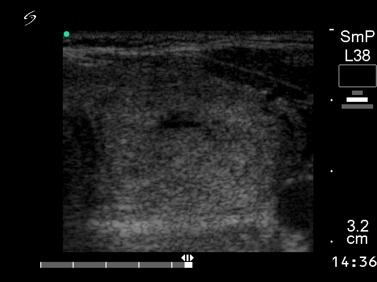 Right lobe, horizontal view