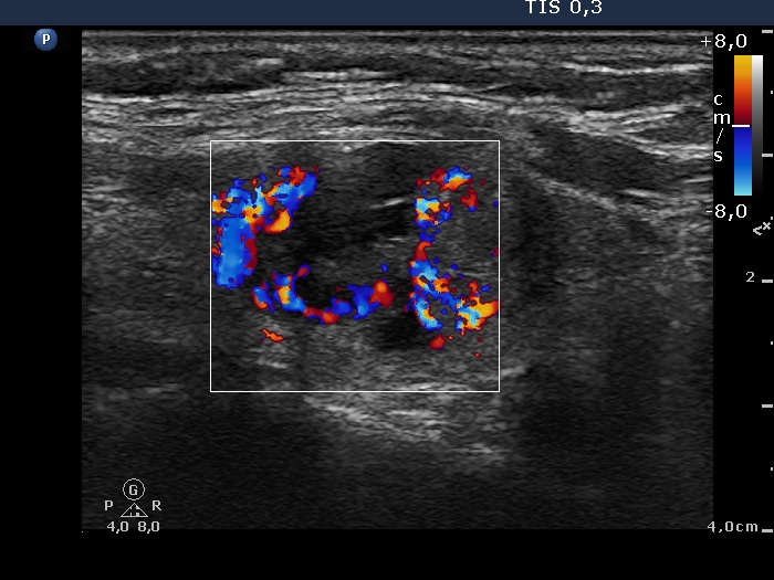 Right lobe, longitudinal scan
