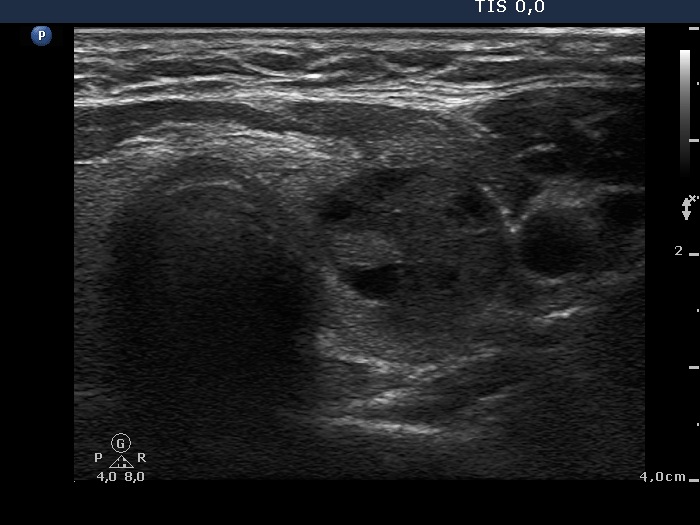 Right lobe, longitudinal scan