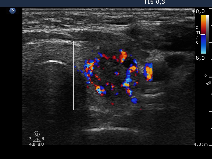 Right lobe, longitudinal scan