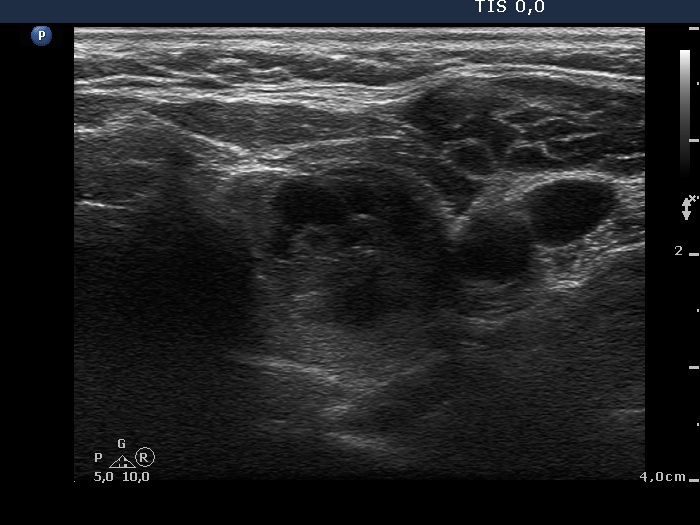 Right lobe, longitudinal scan