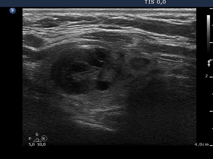 Right lobe, longitudinal scan