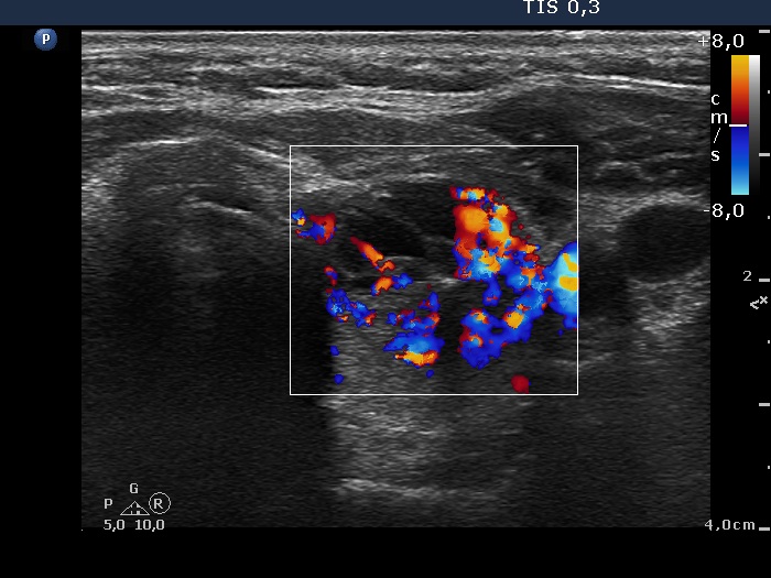 Right lobe, longitudinal scan