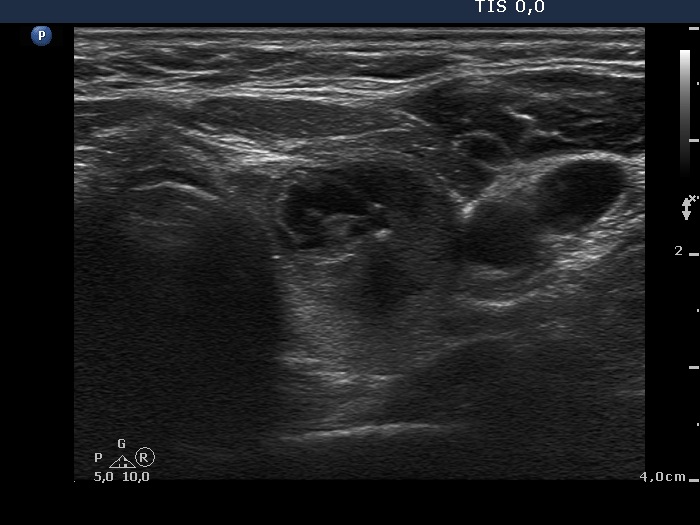 Right lobe, longitudinal scan