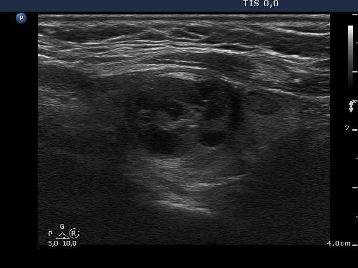 Right lobe, longitudinal scan