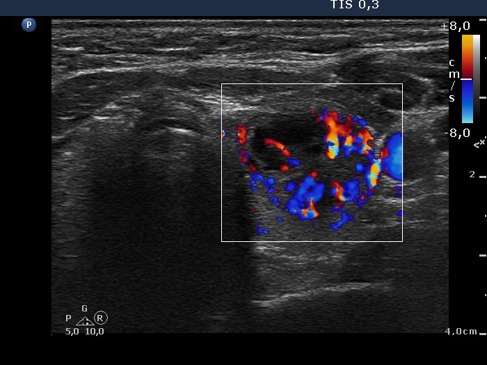 Right lobe, longitudinal scan