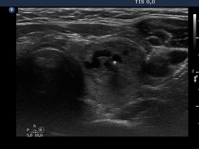 Right lobe, longitudinal scan
