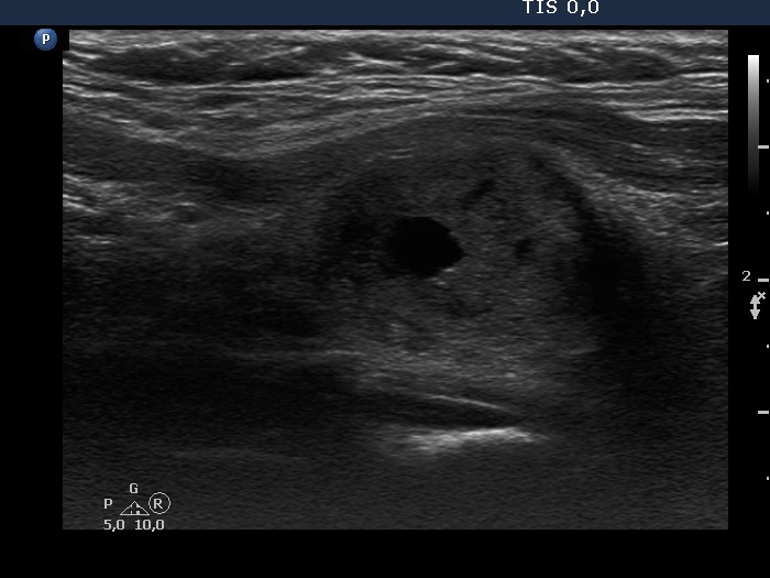 Right lobe, longitudinal scan
