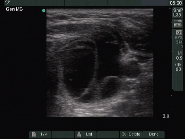 Right lobe, horizontal view