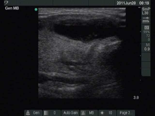 Right lobe, horizontal view